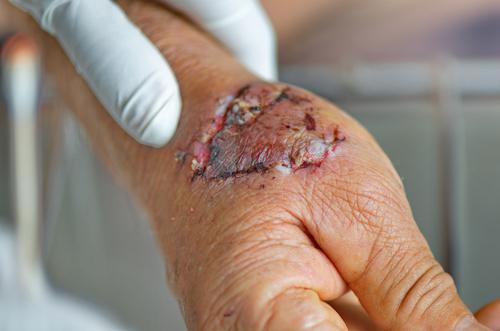 Dog bite wound