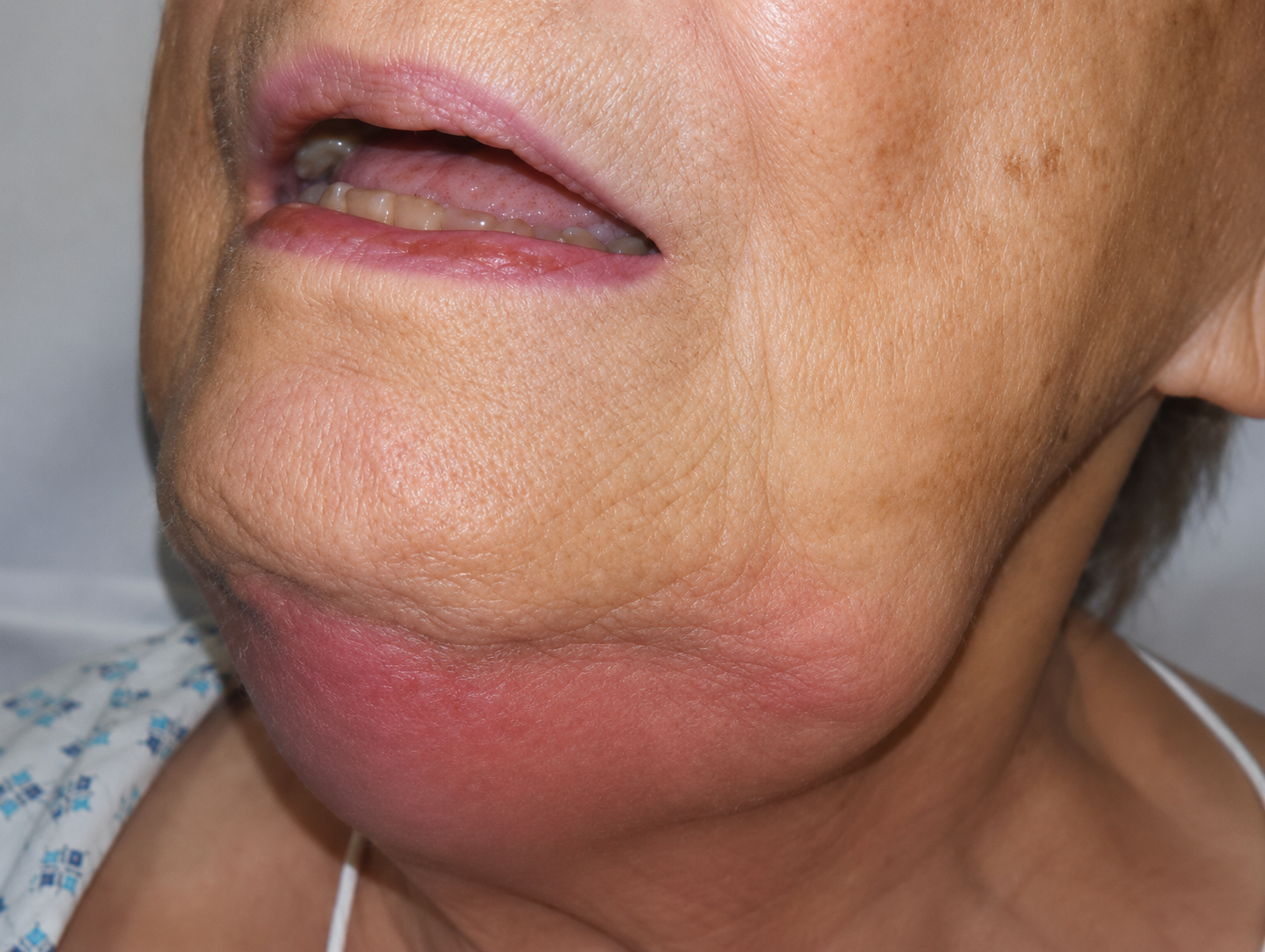 Ludwig's angina affecting the neck