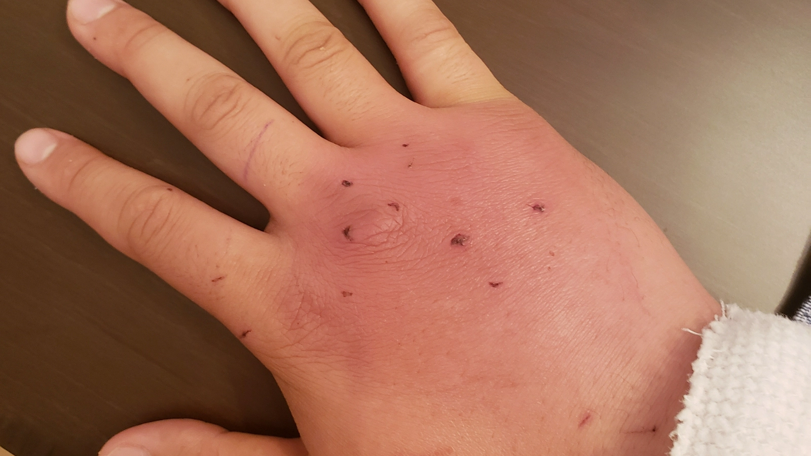 Cat bite wound