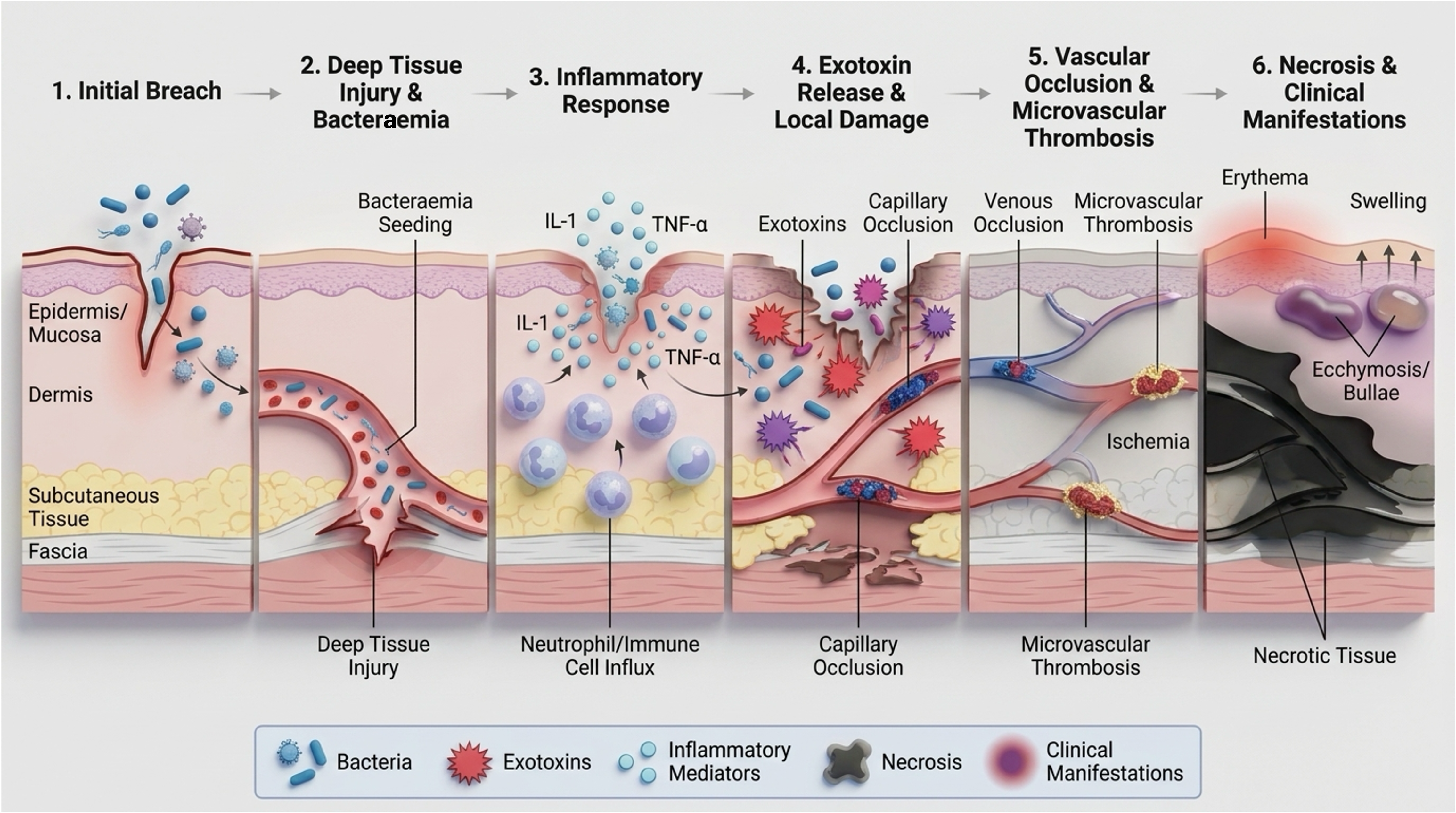 Pathophysiology of necrotising fasciitis