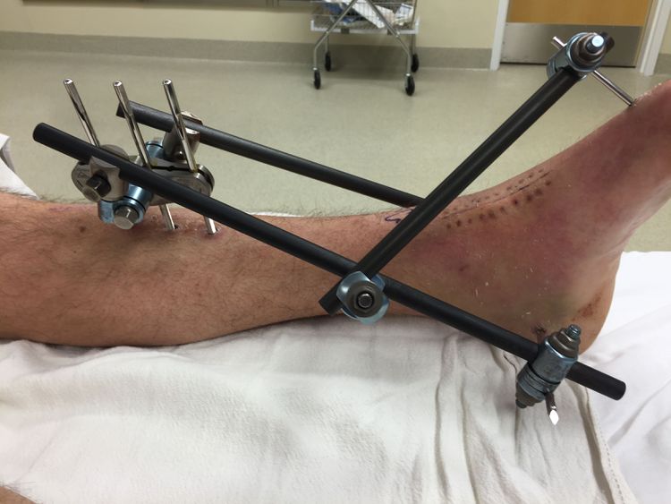 External fixation (ex-fix) applied to an open fracture