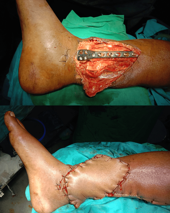 Soft tissue flap coverage of an open fracture