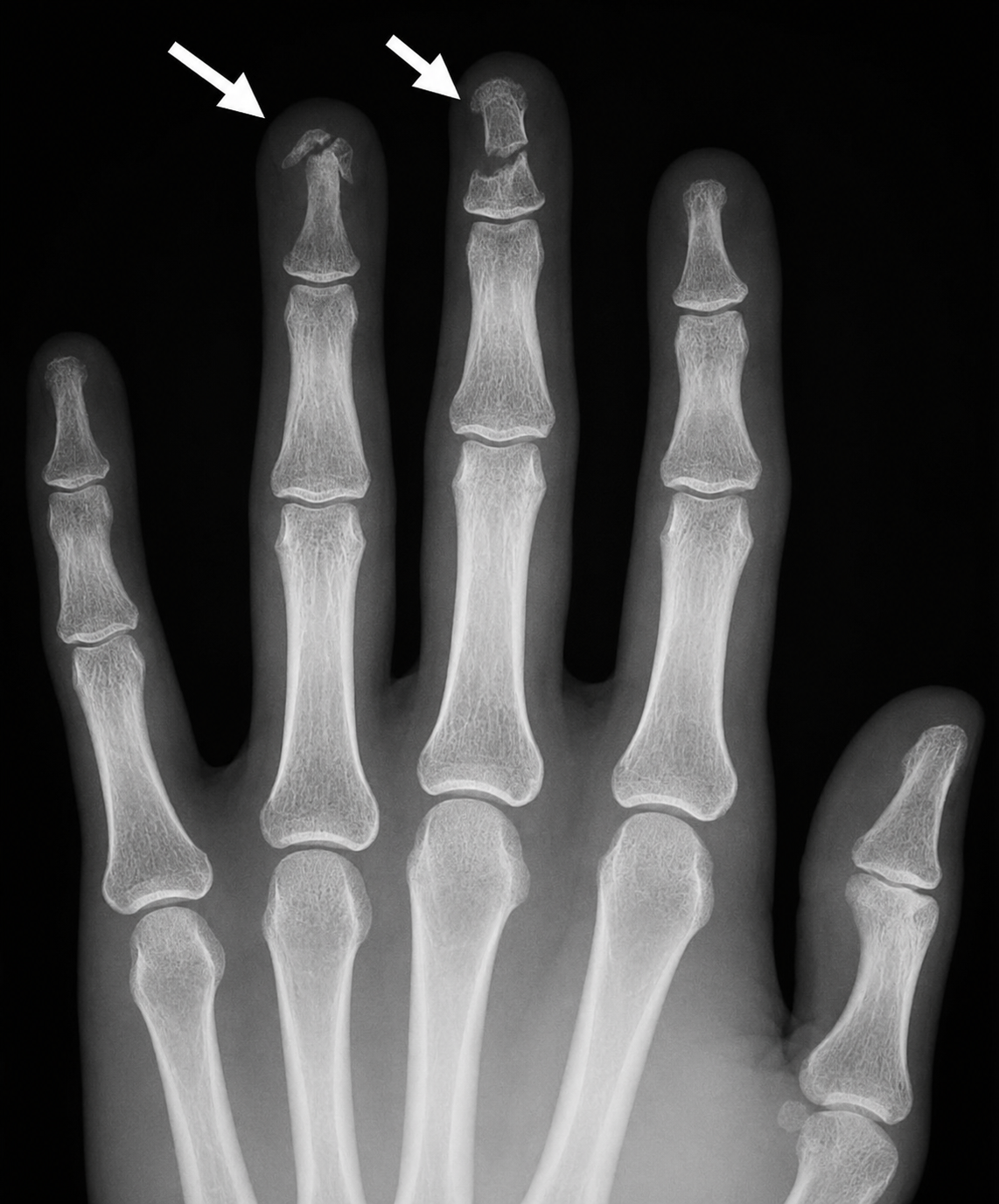 Tuft fracture — radiograph