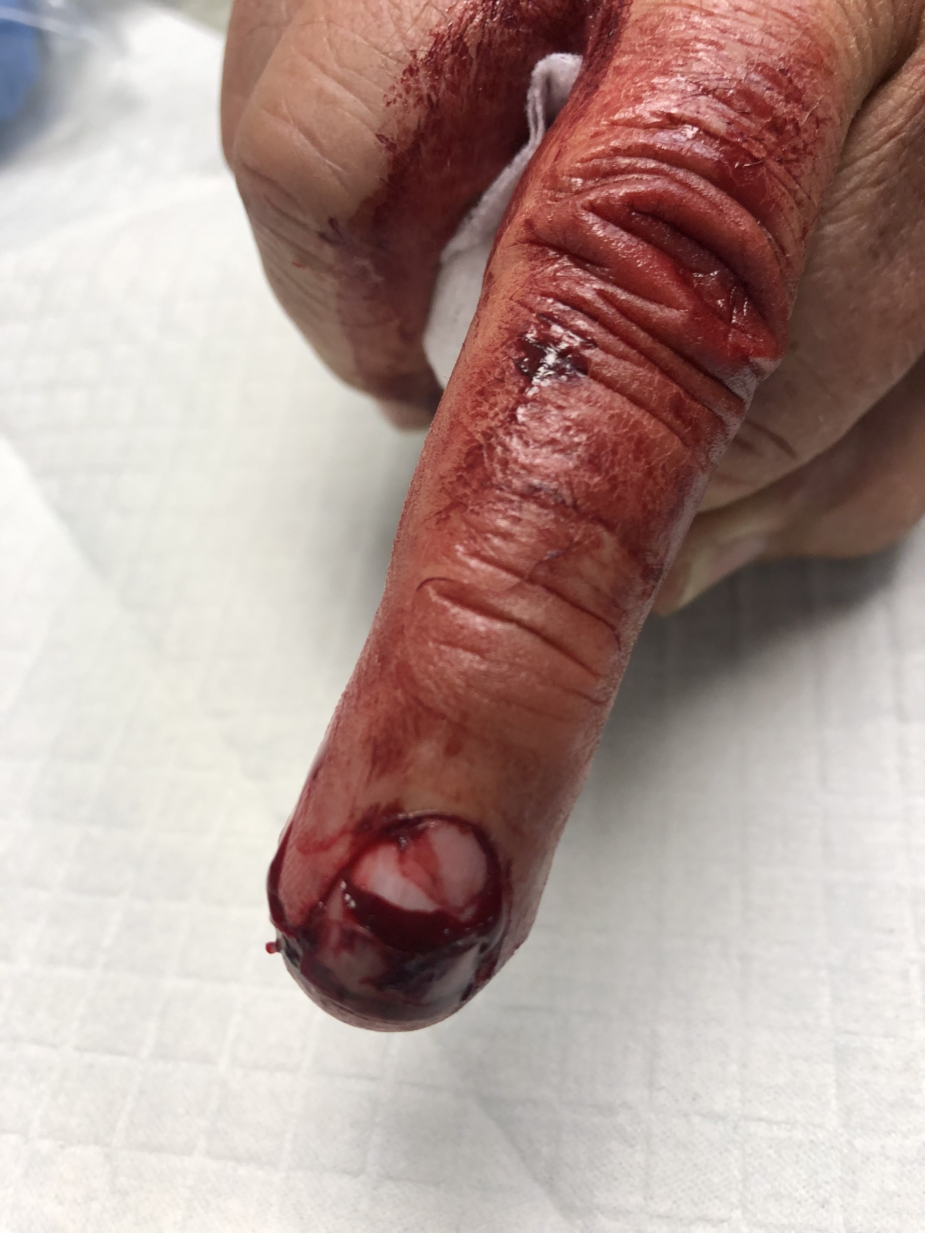 Tuft fracture — clinical appearance